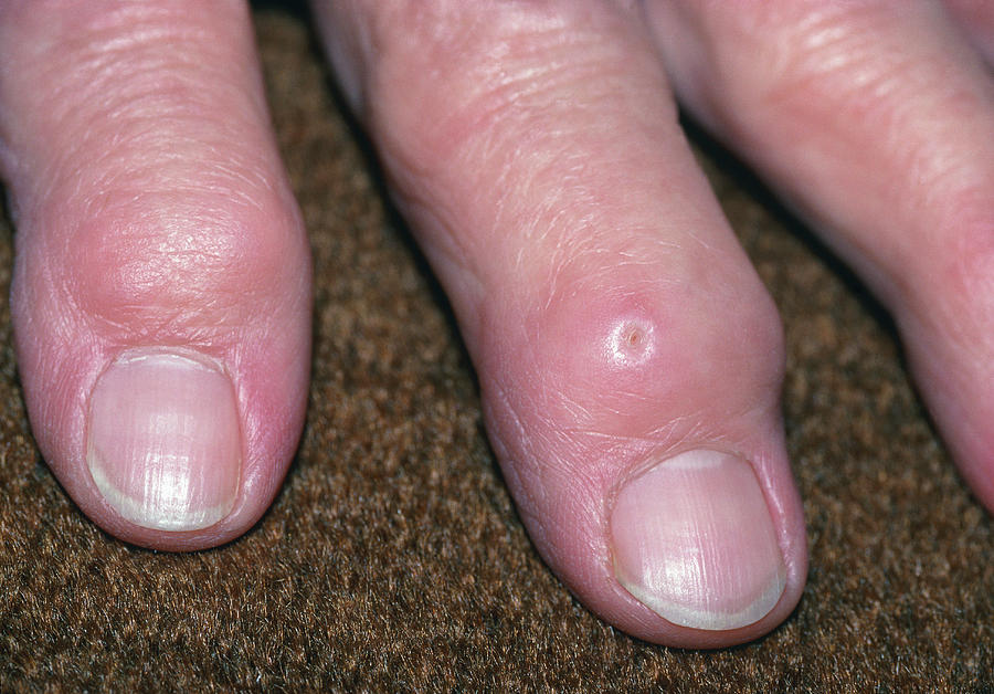 Deformed Fingers Due To Rheumatoid Arthritis Photograph by ...