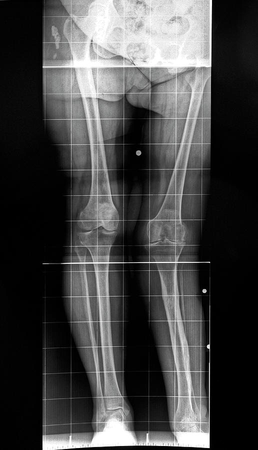 Deformed Knee Photograph by Antonia Reeve/science Photo Library