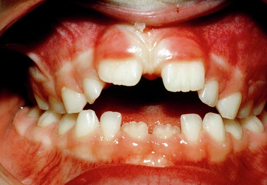 Deformed Teeth Due To Thumb-sucking Photograph by Science Photo Library.