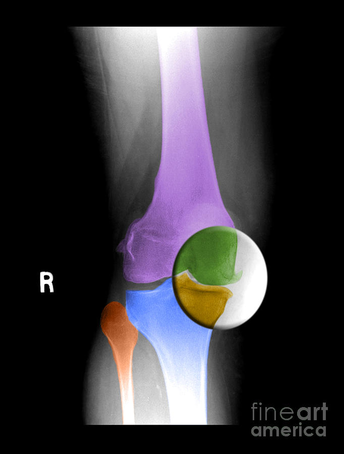 Degenerative Arthritis, Knee Photograph by Living Art Enterprises