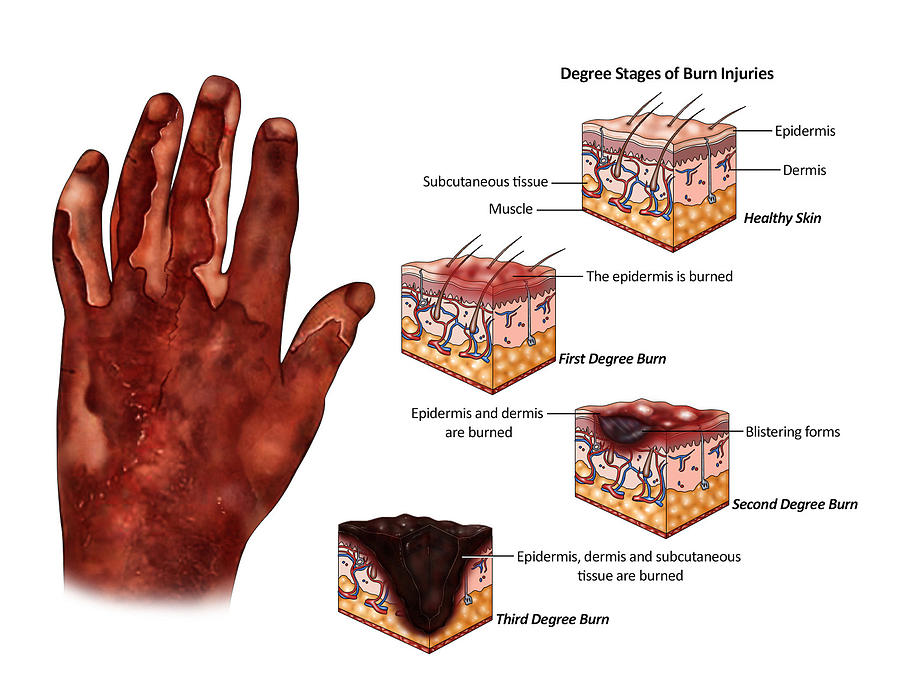 damage associated with a 4th degree burn