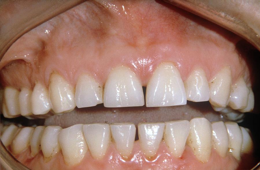 People Photograph - Dental Abrasion by Dr. J.p. Casteyde/cnri