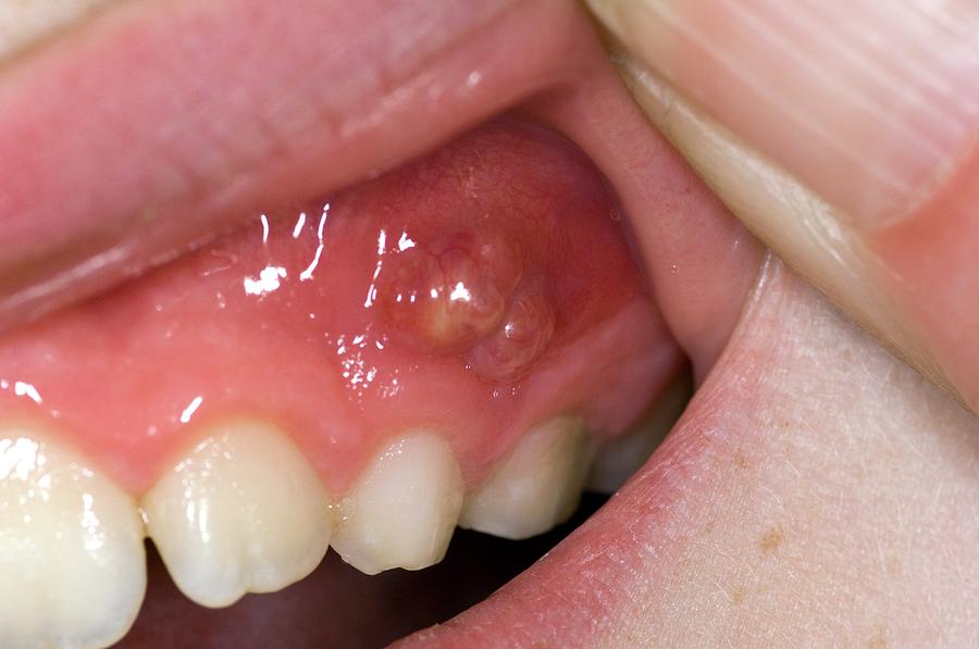 Dental Abscess In A Child Photograph by Dr P. Marazzi 