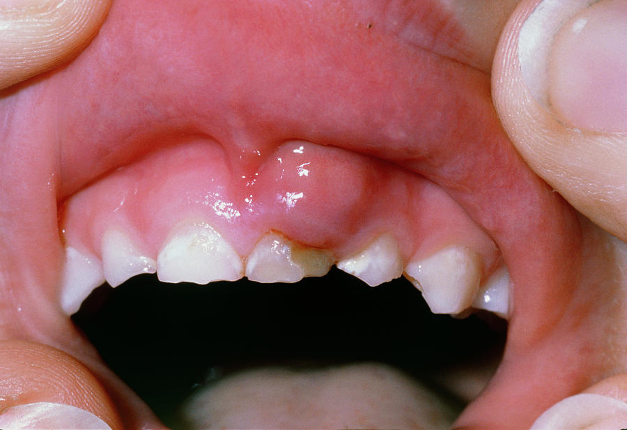 dental-abscess-in-child-photograph-by-dr-p-marazzi-science-photo-library