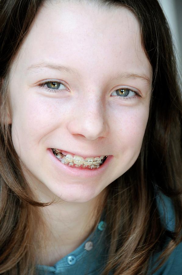 Dental Braces Photograph by Aj Photo/science Photo Library