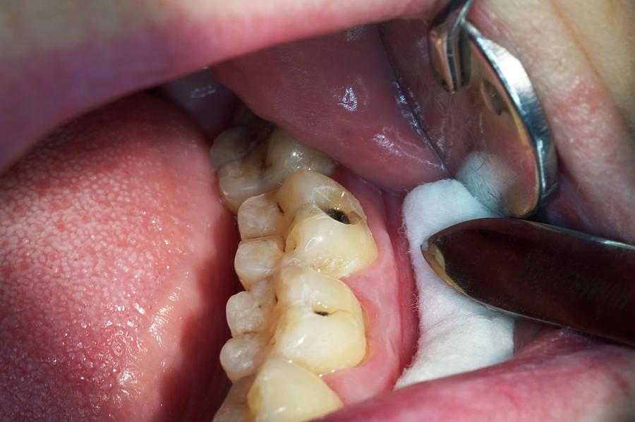 Dental Caries In A Molar Photograph By Dr Armen Taranyan Science