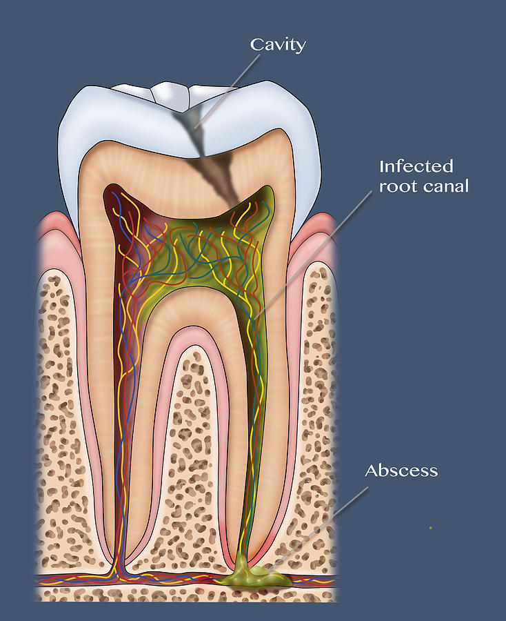 Dental Cavity And Abscess, Illustration Photograph by Monica Schroeder