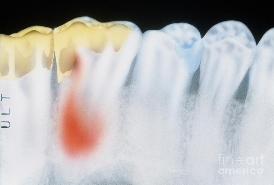 Dental Filling And Cavity Photograph by Chris Bjornberg | Fine Art America