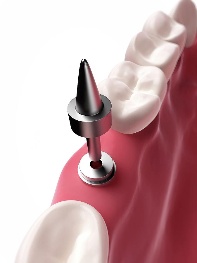 Illustration Photograph - Dental Implant by Sebastian Kaulitzki