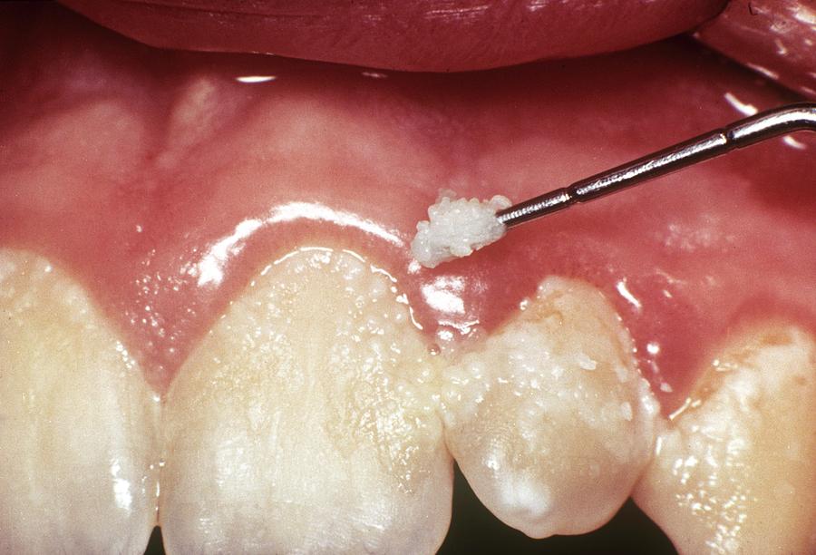 dental-plaque-and-gum-disease-photograph-by-cnri-fine-art-america