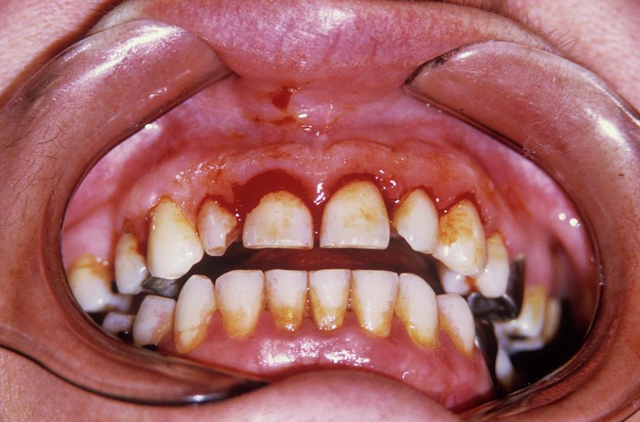 People Photograph - Dental Plaque And Gum Disease by Dr. J.p. Casteyde/cnri