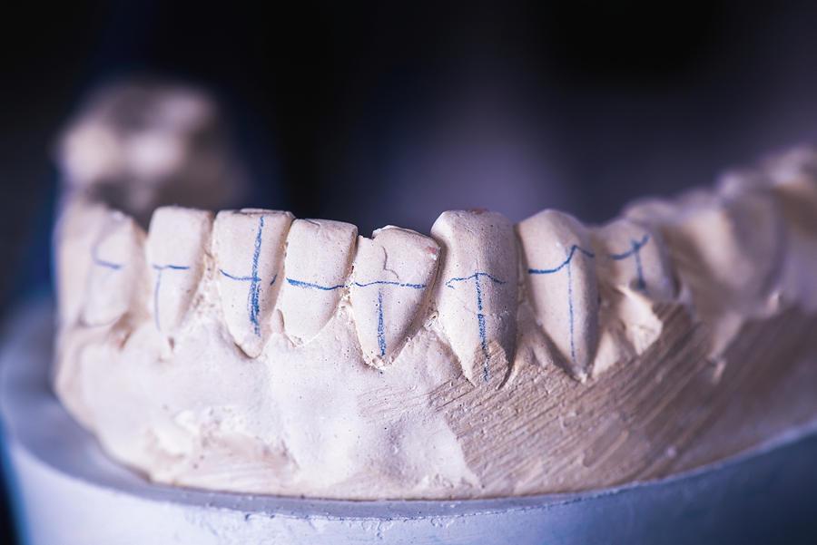 Dental Prosthesis With Markings Photograph by Ktsdesign/science Photo ...