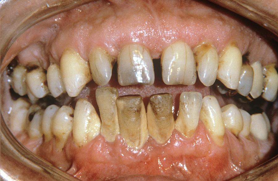 People Photograph - Dental Tartar by Dr. J.p. Casteyde/cnri