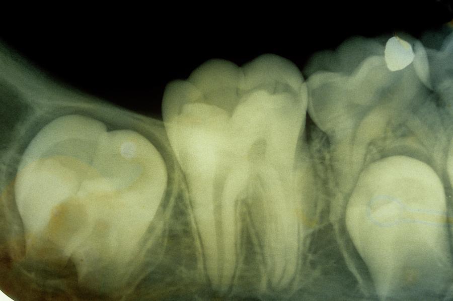 6 Photograph - Dental X-ray by Dr. J.p. Casteyde - Cnri