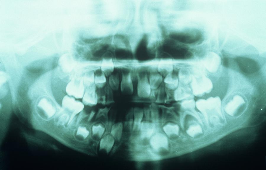 Dental X-ray Photograph by Science Photo Library Dental X-ray Photograph by Science Photo Library