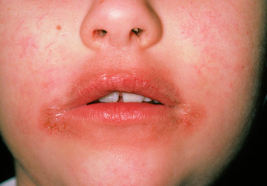 Dermatitis Around The Mouth Of A Child Photograph by Dr P. Marazzi