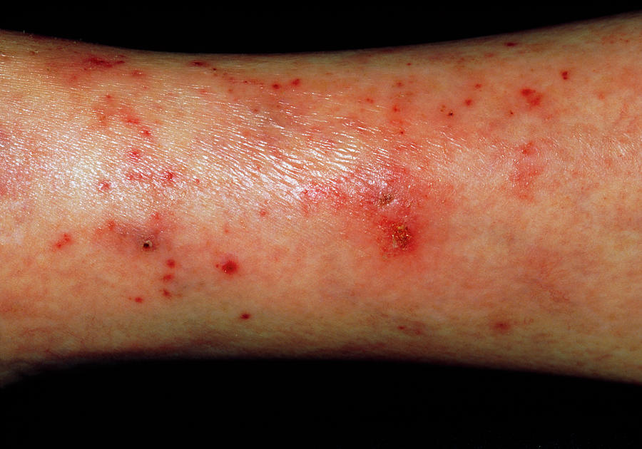 Dermatitis Artefacta In An Alcoholic Patient Photograph By Dr P