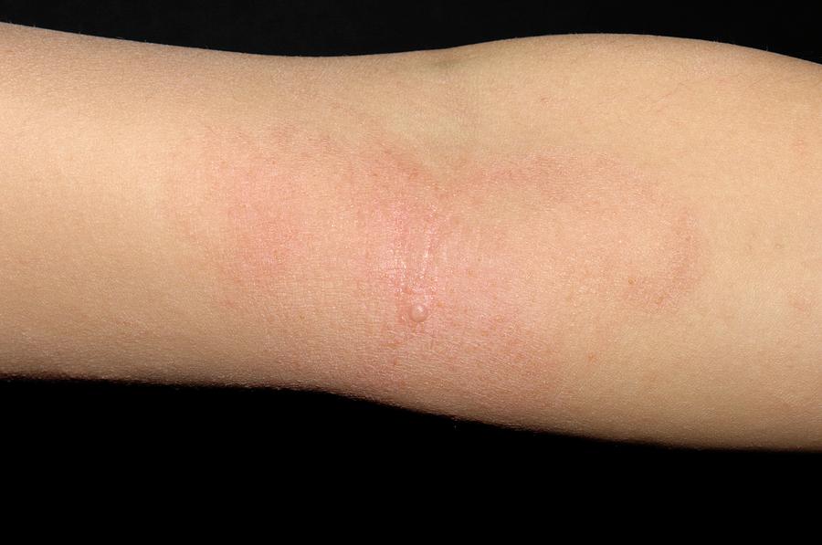 Dermatitis Photograph By Dr P Marazziscience Photo Library 