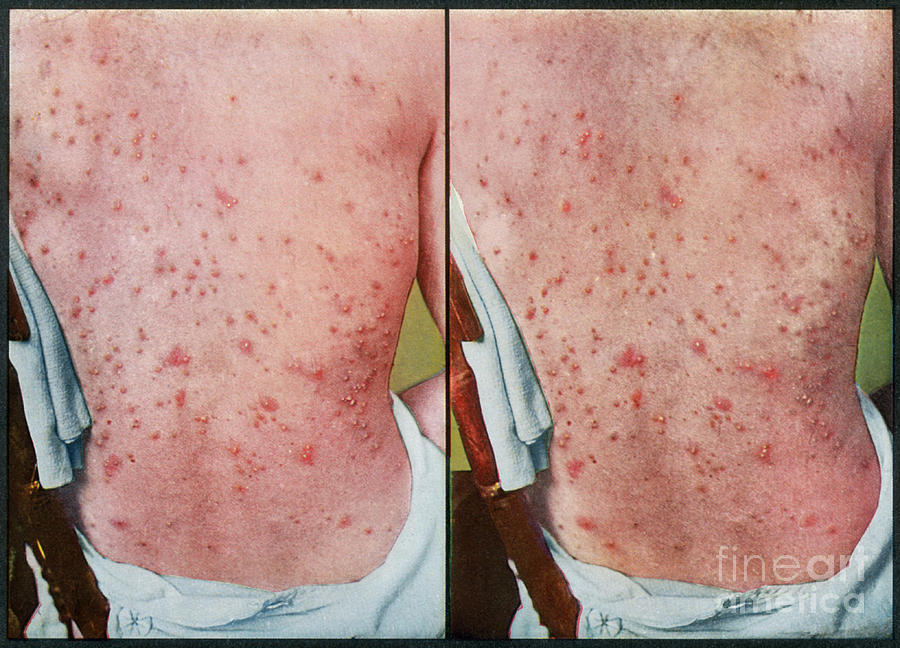 Dermatitis Herpetiformis, Vintage Photograph by DoubleVision