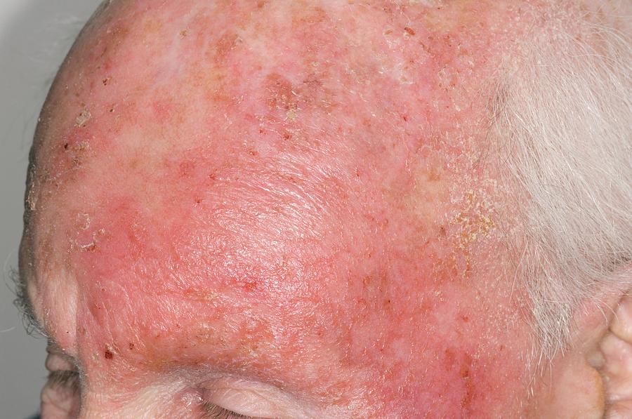 Dermatitis Of The Head From Drug Allergy Photograph By Dr P Marazzi