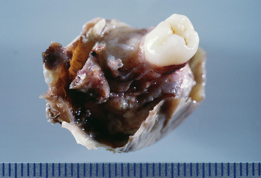 Dermoid Cyst Of The Ovary Photograph by Cnri/science Photo Library