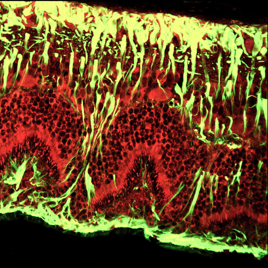 Detached Retina Photograph by C.j.guerin, Phd, Mrc Toxicology Unit/ Science Photo Library