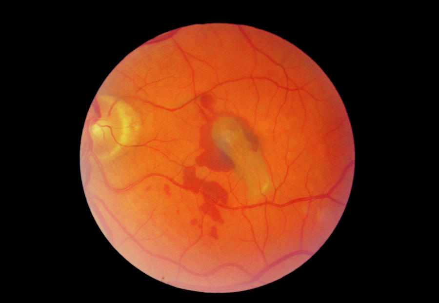 Detached Retina Photograph by Paul Parker/science Photo Library