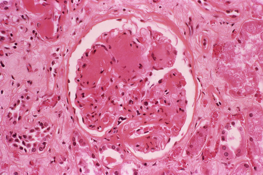 Diabetic Kidney Photograph by Cnri/science Photo Library