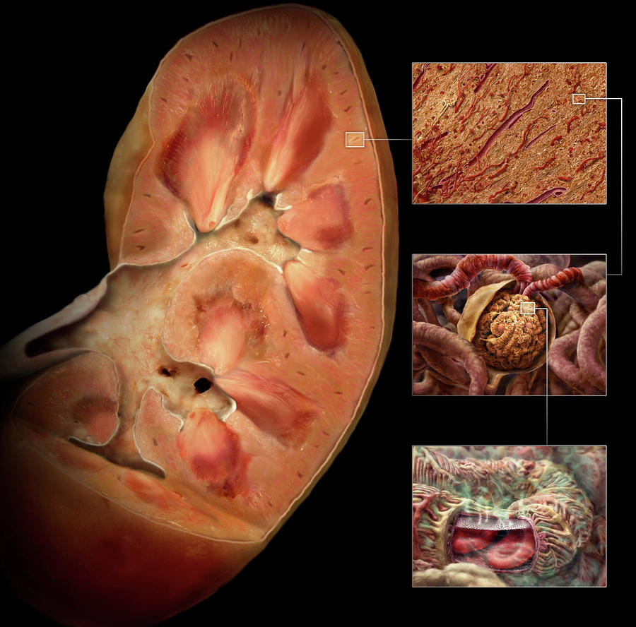 Diabetic Kidney Damage Photograph by Anatomical Travelogue