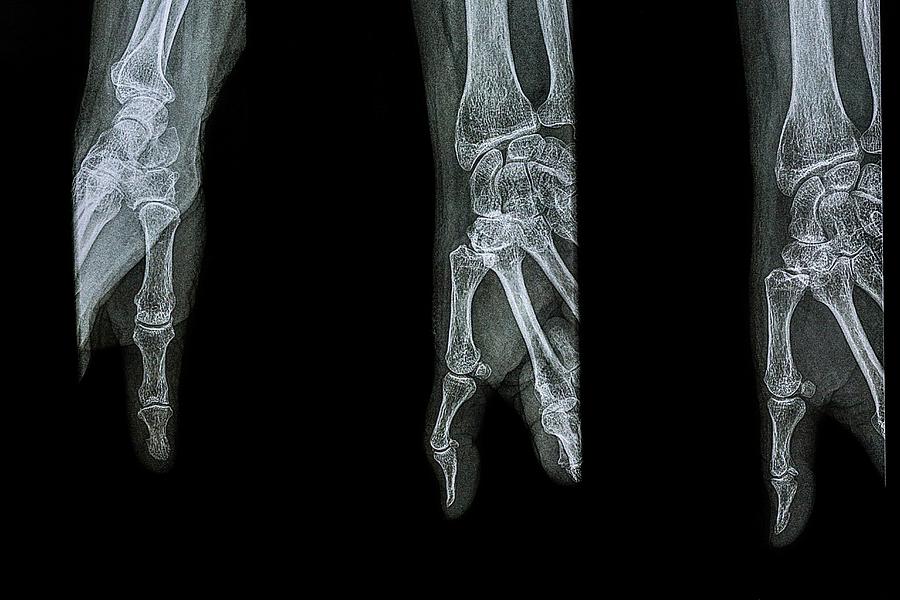 Diagnostic Thumb X-rays Photograph by Brian Gadsby/science Photo Library