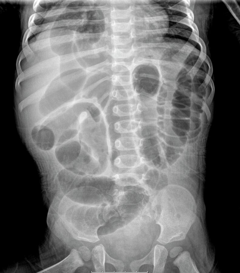 Diaphragmatic Hernia Chest X Ray