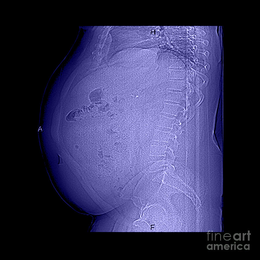 Digital X-ray Of Obesity, 1 Of 2 Photograph by Living Art Enterprises