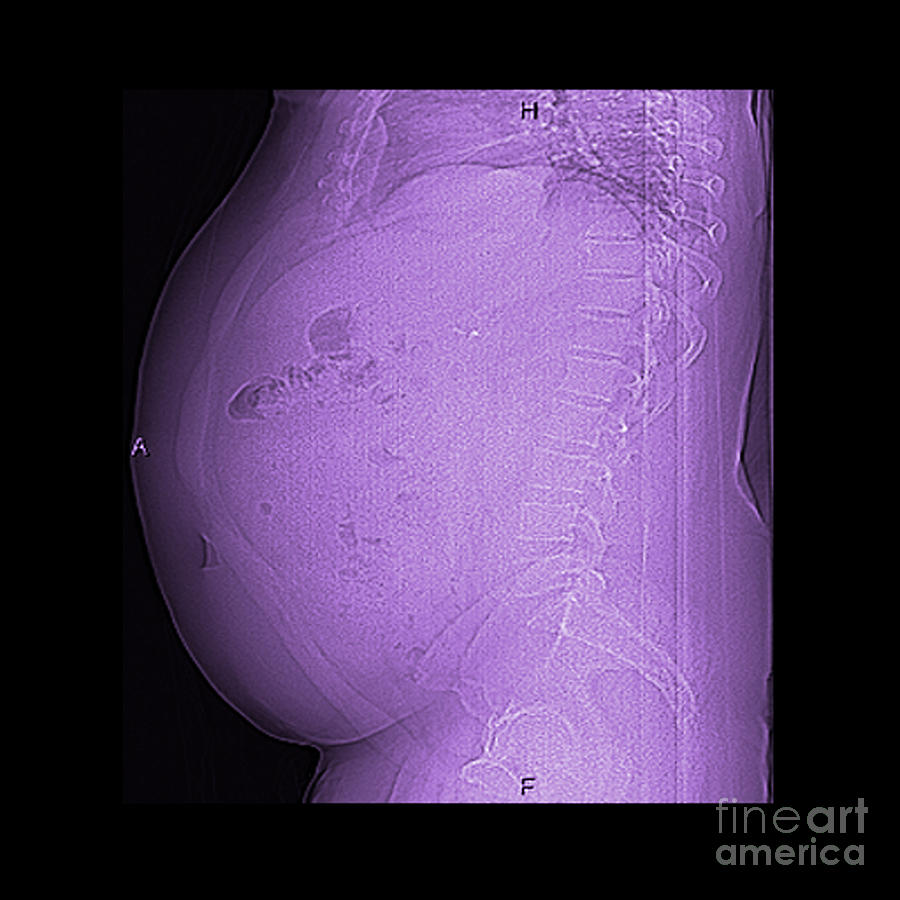 Digital X-ray Of Obesity, 2 Of 2 Photograph by Living Art Enterprises