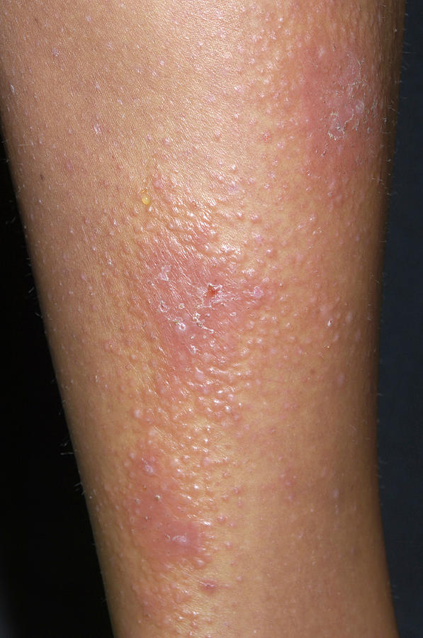 Discoid Eczema Photograph By Dr P Marazzi Science Photo Library