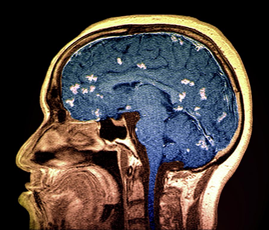 Diseased Brain Photograph by Science Photo Library - Pixels