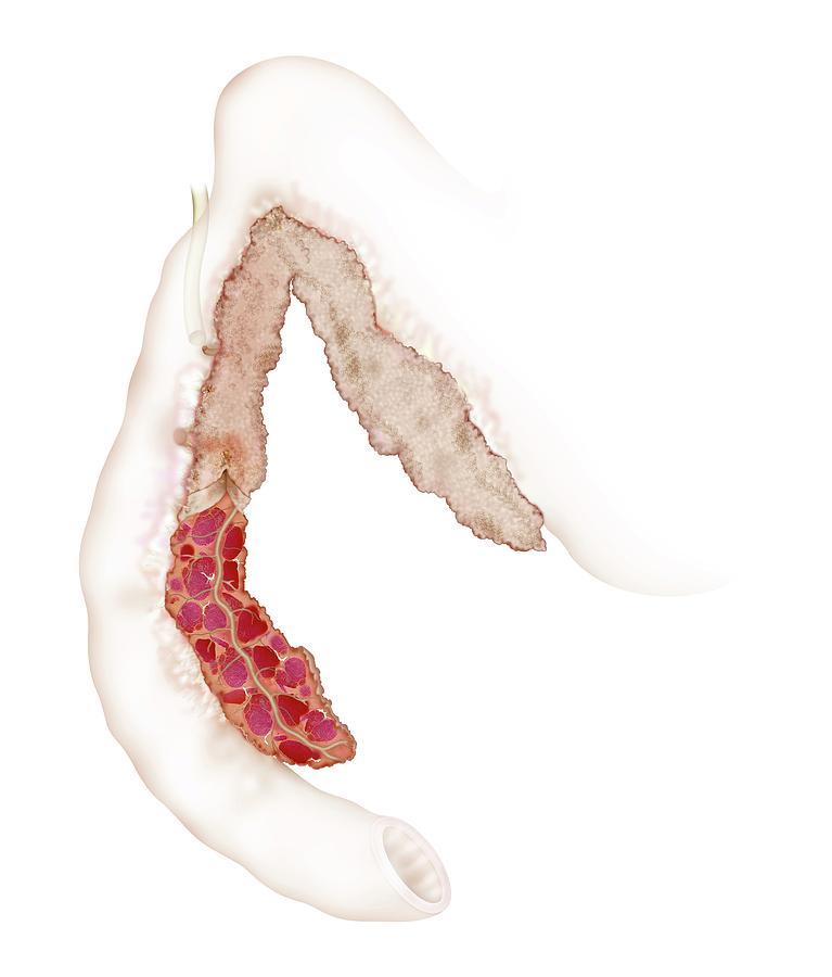 Nature Photograph - Diseased Canine Pancreas by Samantha Elmhurst/science Photo Library