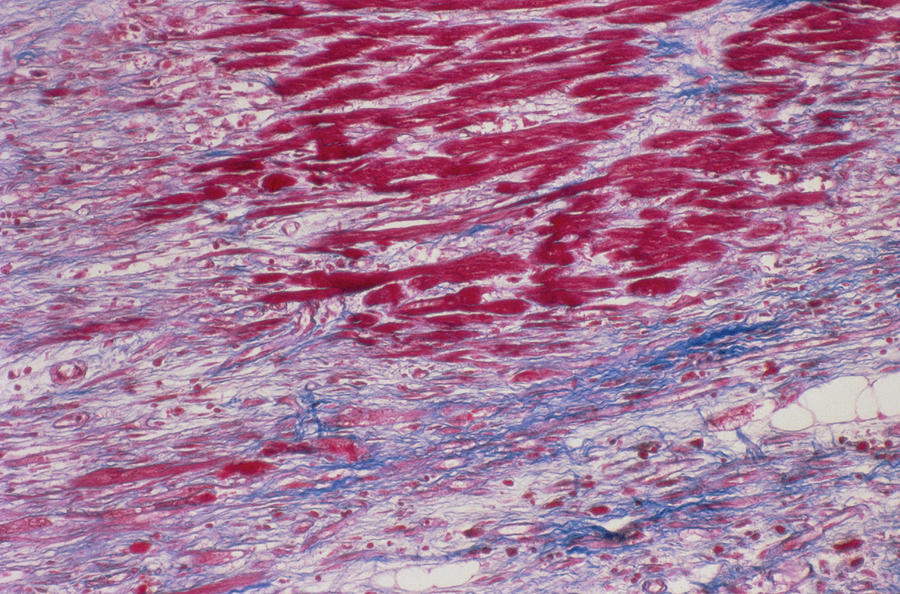 Diseased Heart Tissue Photograph by Cnri/science Photo Library