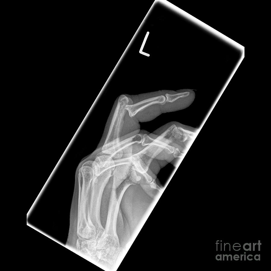Dislocated Finger X Ray Photograph By Science Photo Library