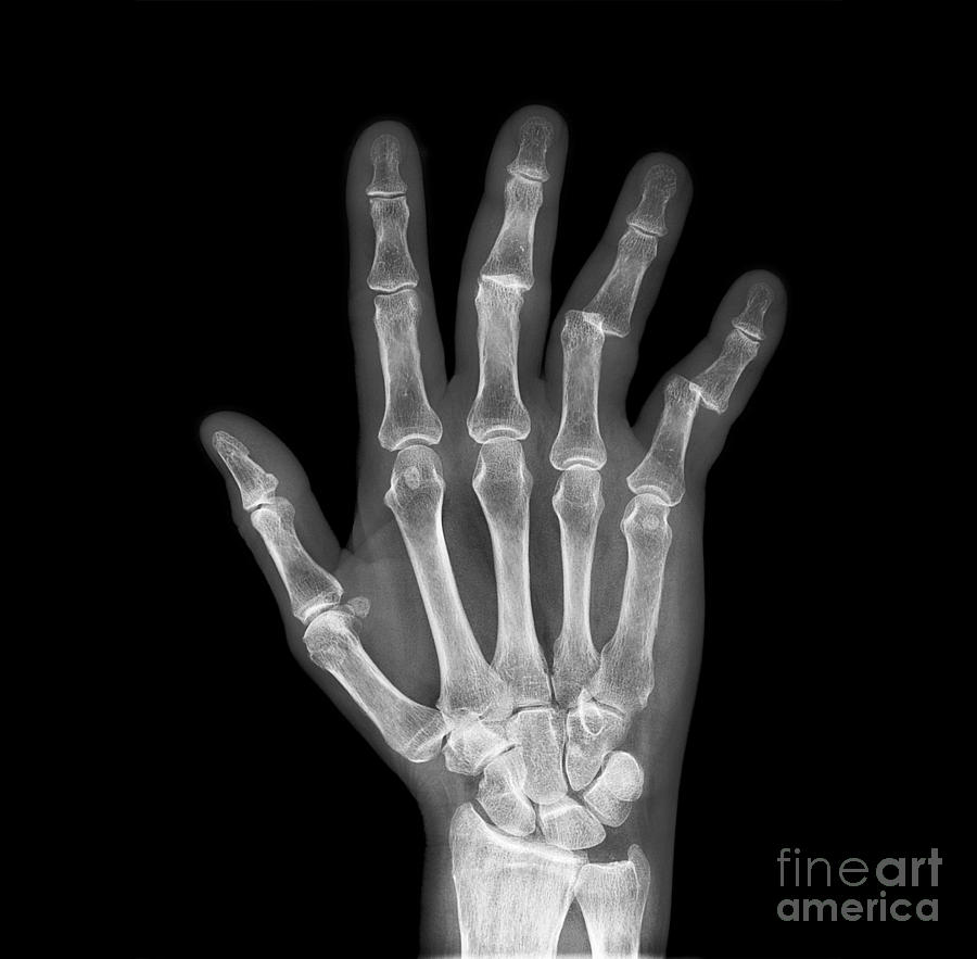 Dislocated Fingers, X-ray Photograph by Science Photo Library - Pixels