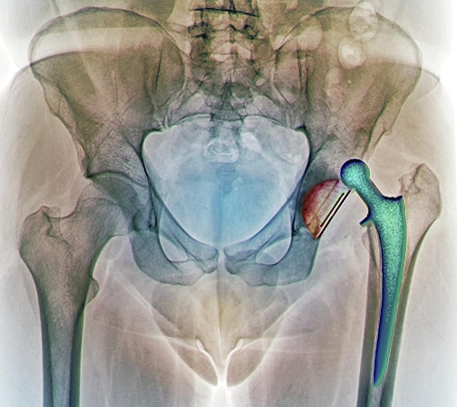 Dislocated Hip Replacement, X-ray Photograph by Zephyr