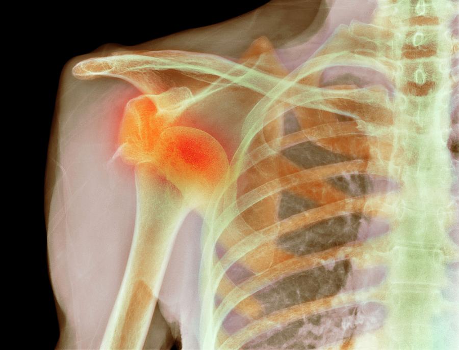 Dislocated Shoulder Photograph by Science Photo Library
