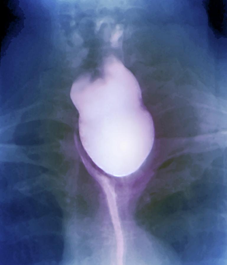 Swallow Photograph - Diverticulum In The Oesophagus by Zephyr/science Photo Library