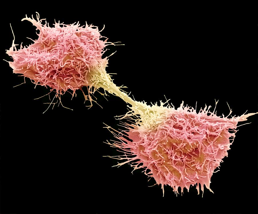 Dividing fibrosarcoma cells, SEM Photograph by Science Photo Library - STEVE GSCHMEISSNER.