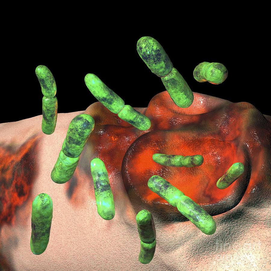 Klebsiella Granulomatis Photograph - Donovanosis Infection, Artwork by Russell Kightley