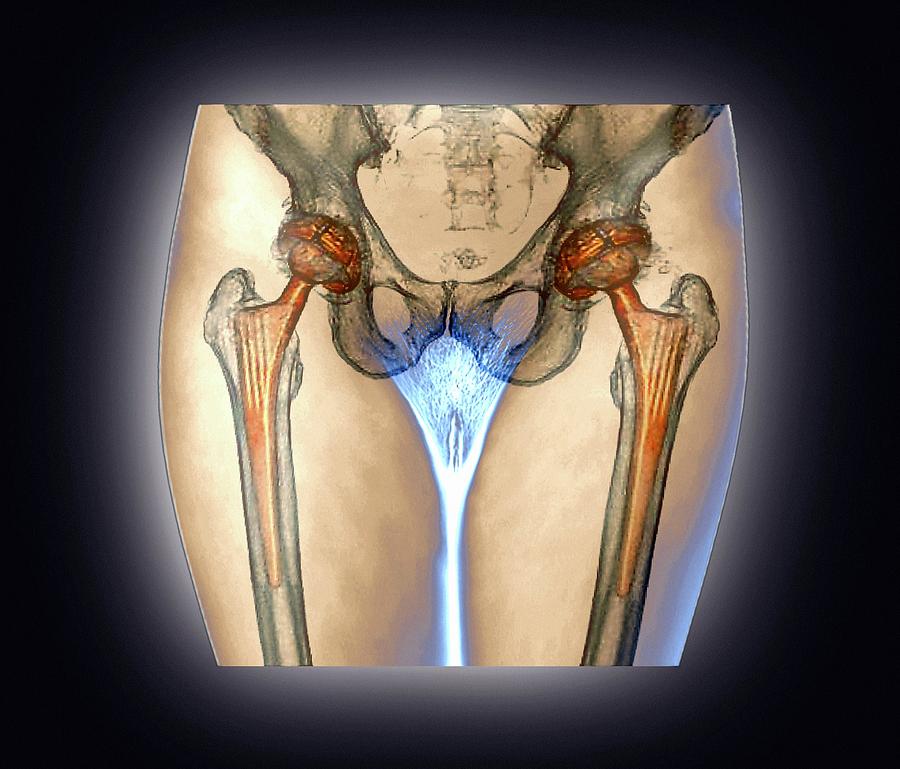 Human Photograph - Double Hip Replacement by Zephyr