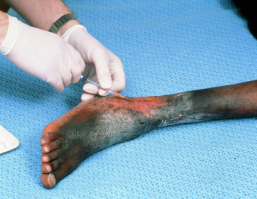 Sickle Cell Photograph - Drug Treatment Of Ulcer In Sickle Cell Patient by Alex Bartel/science Photo Library