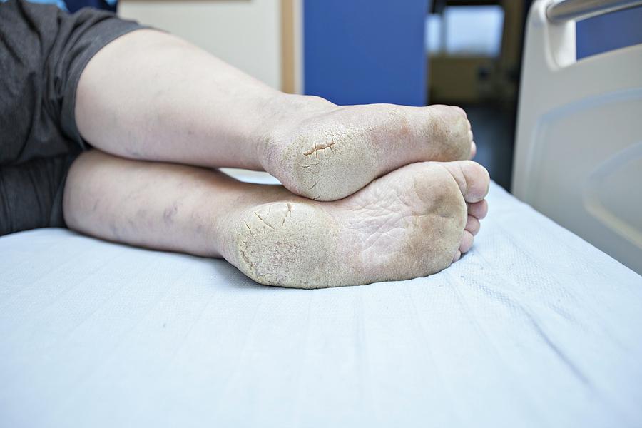 Dry And Cracked Feet In Diabetes Photograph by Lewis Houghton/science