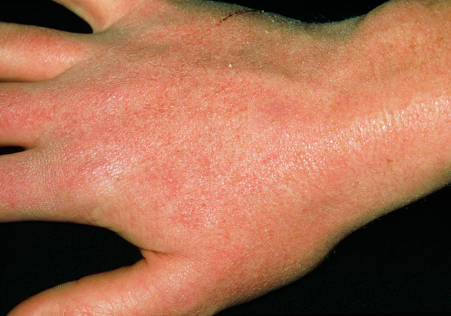 Dry Skin Reaction On Hand Due To Anti-acne Drug Photograph by Dr P ...