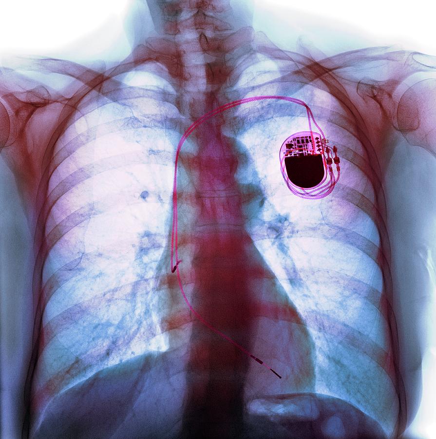 Dual Chamber Pacemaker Photograph by Science Photo Library