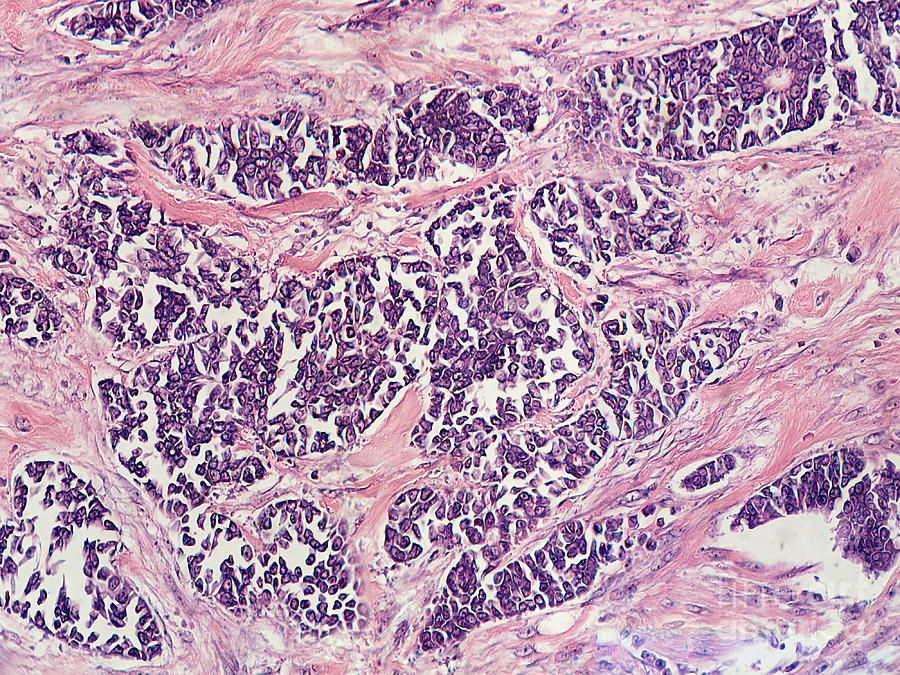 Ductal Breast Carcinoma, Lm Photograph by Garry DeLong